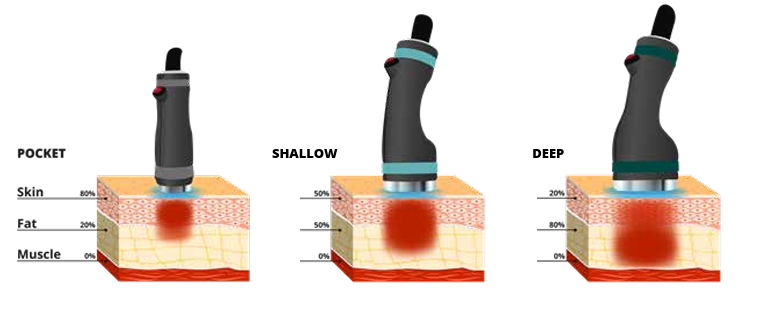 Die drei ONDA PRO Handstücke Pocket, Shallow und Deep mit ihren Wirkbereichen in Haut und Fettgewebe
